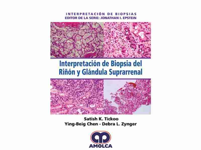 Biopsia Riñon Interpretación de Biopsia del Riñón y Glándula Suprarrenal ...